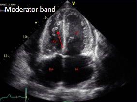 <p>Muscular structure located in the right ventricle of the heart.</p><p>Can be mistaken for a right heart thrombus.</p>