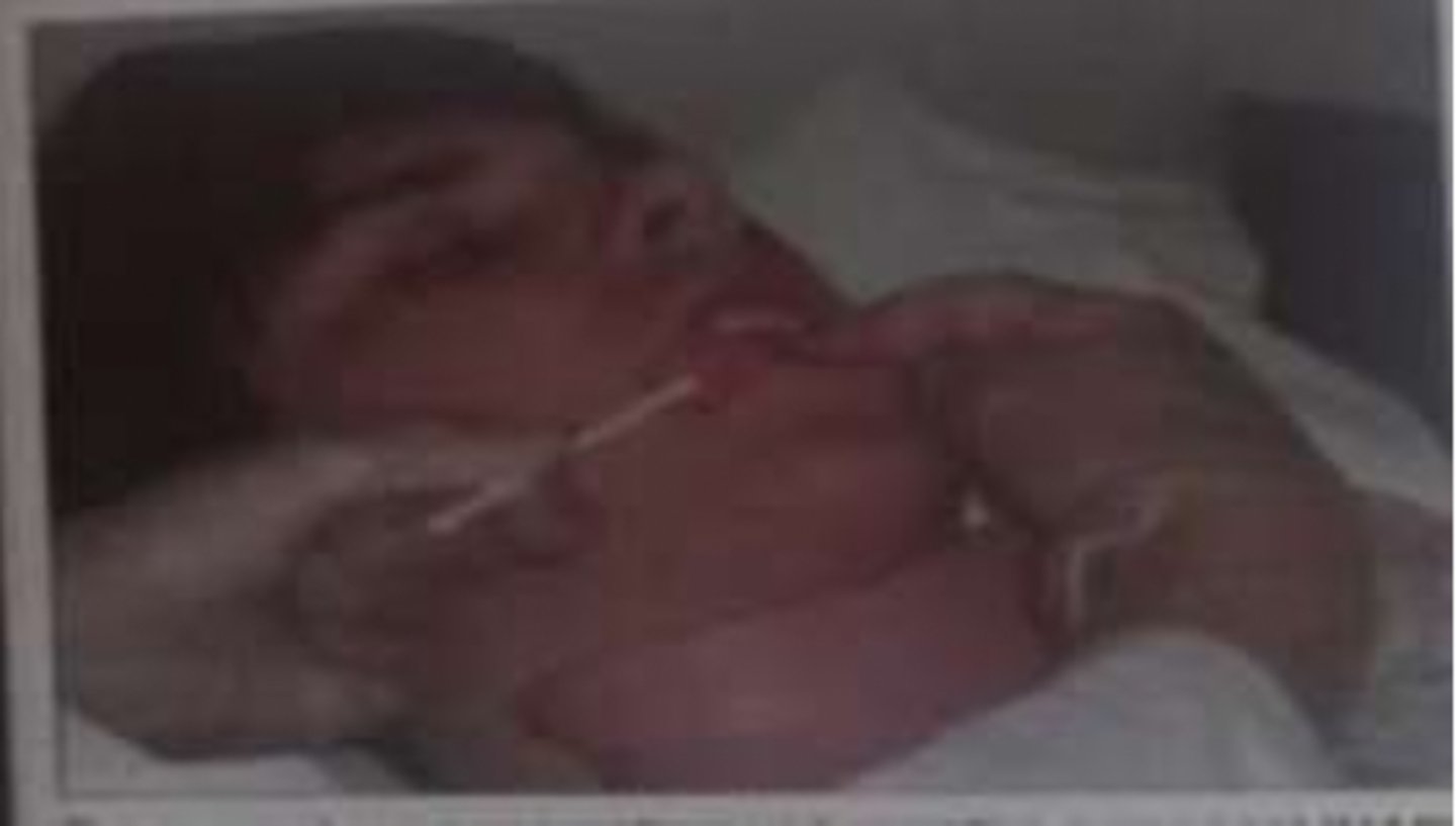 <p>Turn the clients head to the side.</p><p>Remove the gloved finger from the mouth.</p><p>Elevate the head of the bed to semi fowlers</p>