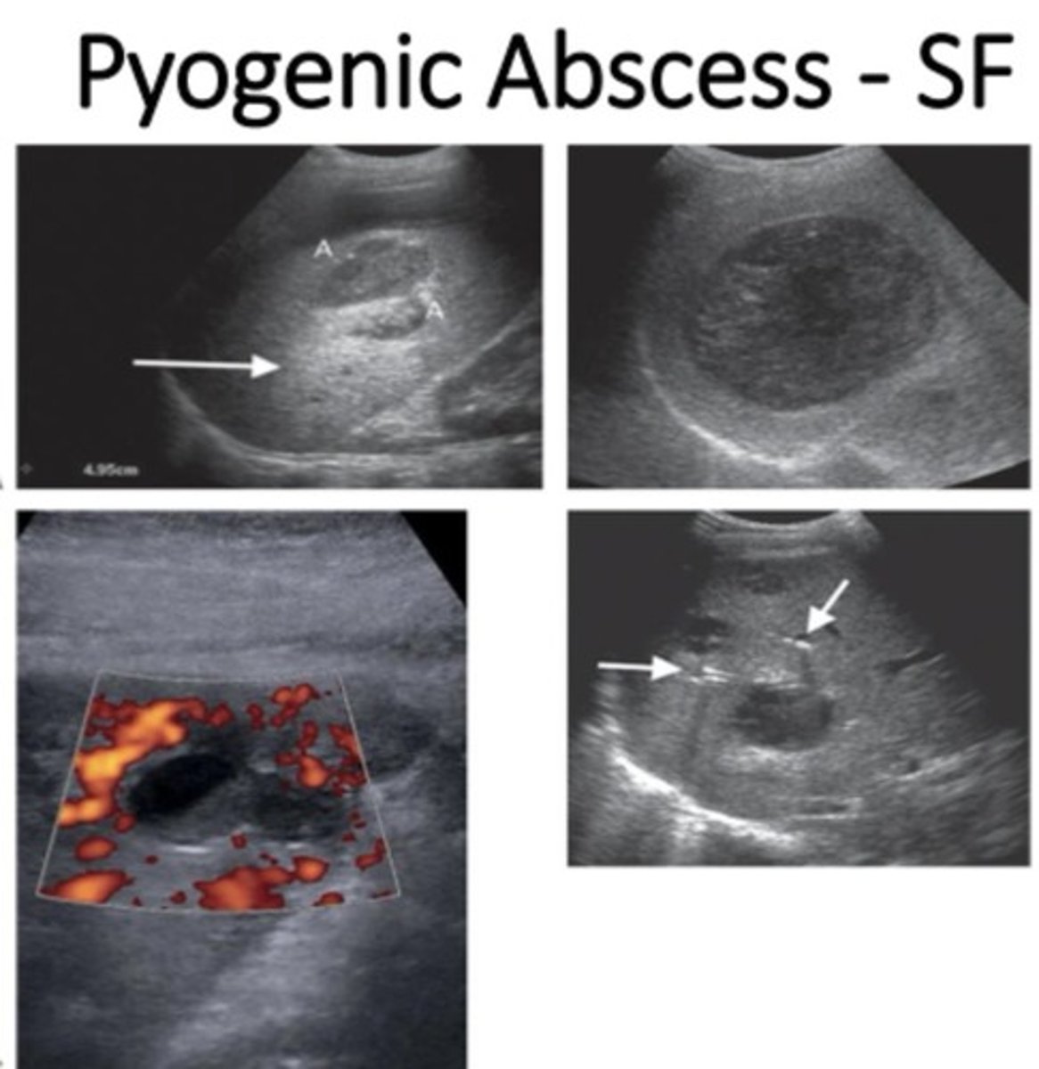 <p>- Fluid filled with posterior enhancement</p><p>- Pus: can be echofree or highly echogenic (variable appearance)</p><p>- Internal septations, debris</p><p>- Gas forming bacteria make hyperechoic foci</p><p>- Increased flow surrounding abscess (not within abscess)</p>