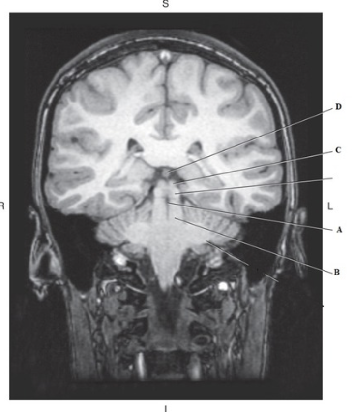 <p>Time for axis realignment (brightest) fat - white matter - grey matter - CSF (darkest)</p>