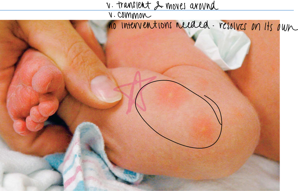 <p>newborn rash </p>