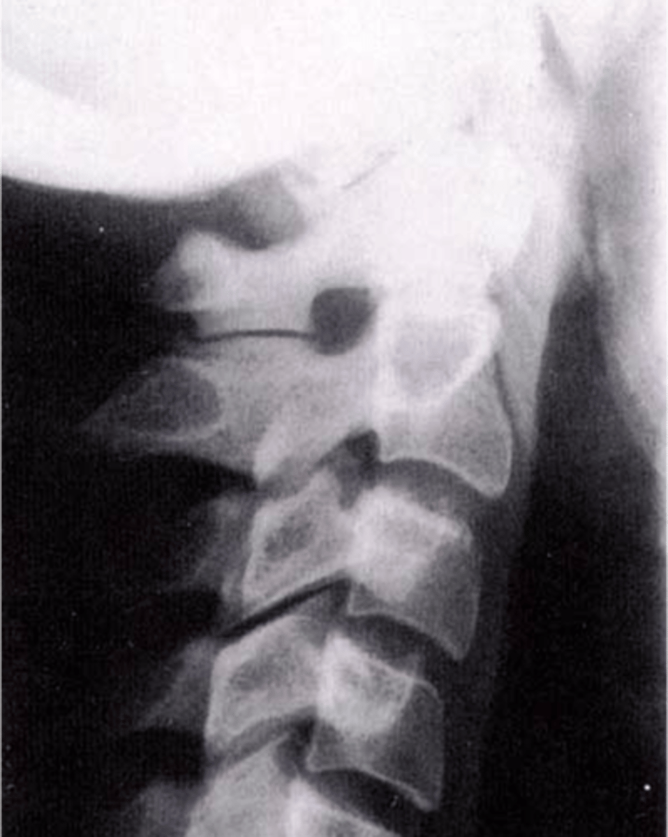 <p>Accessory articulations are often asymptomatic, but can restrict _____</p>