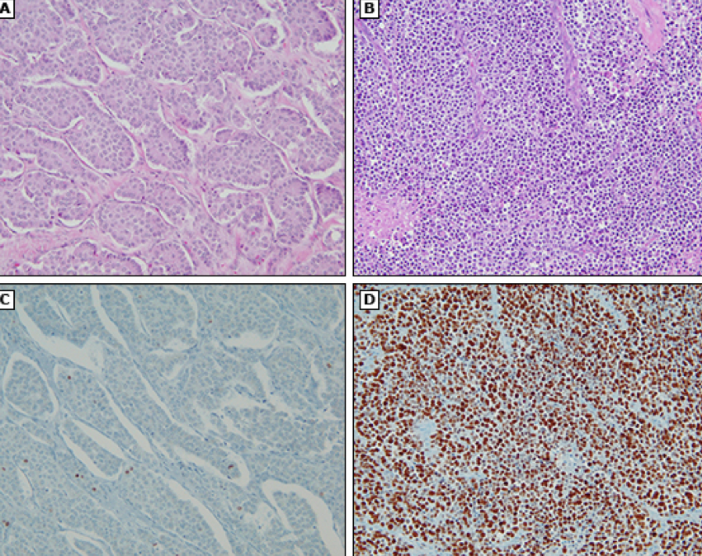 <p>stain that can be used to differentiate the proliferation rates of different types of gastric NETs</p>