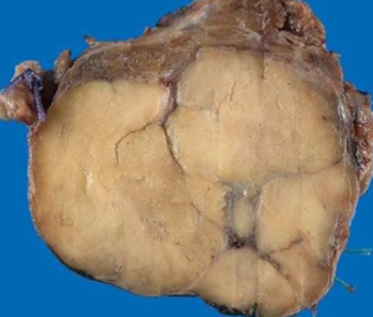 <p>gross pathology: solitary nodules well circumscribed with thick white fibrous capsule</p><p>-nodules are yellow tan on cut section</p>