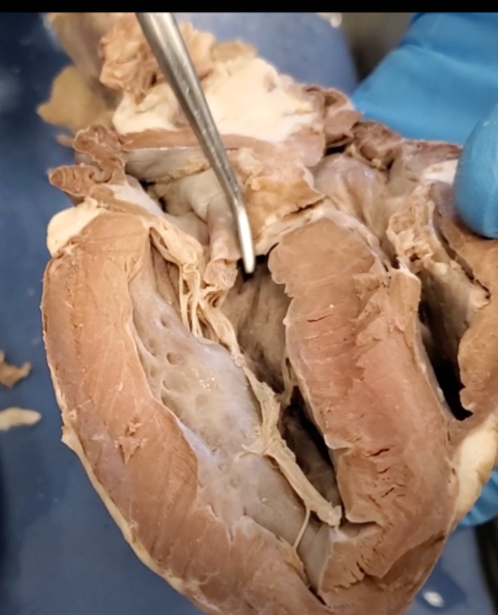 <p>located between the left ventricle and the aorta</p>