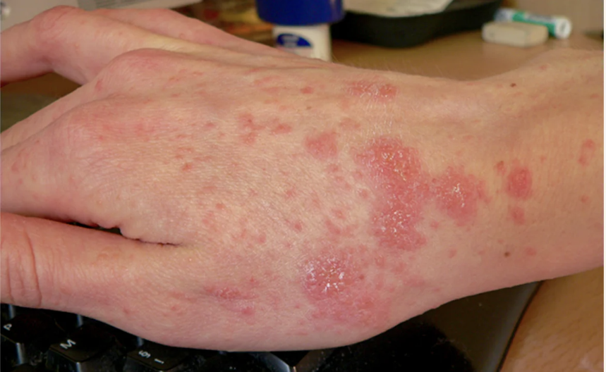 <p>“the itch”, contagious parasitic skin infection that causes inflammation and intense itching</p><ul><li><p>refer these paitents</p></li></ul><p></p>