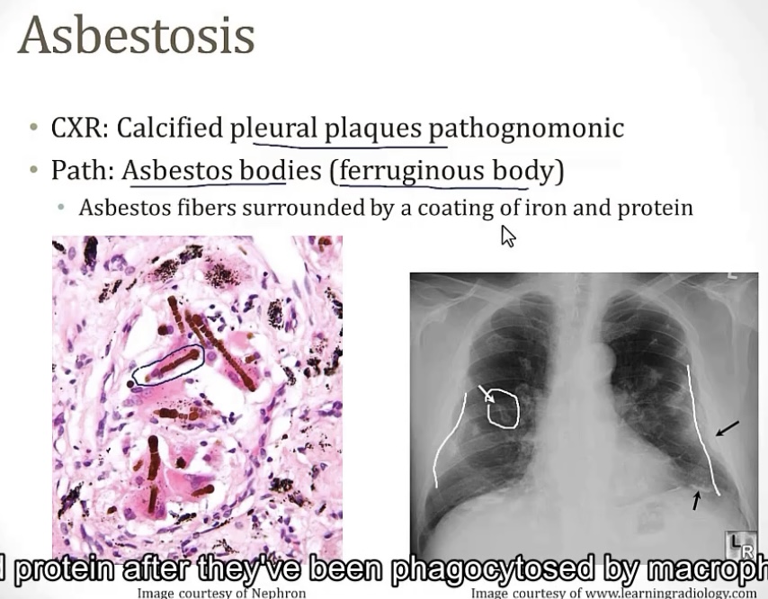 <p>-restrictive</p><p>-honeycomb</p><p>-idiopathic pulmonary fibrosis; sarcoidosis; pneumoconiosis; hypersensitivity pneumonitis; medications</p><p>IDIOPATHIC PULMONARY FIBROSIS…</p><p>-idiopathic</p><p>-dyspnea</p><p>-40</p><p>PNEUMOCONIOSIS…</p><p>-coal dust; mines; smoking</p><p>-upper portion; small, rounded nodular opacities</p><p>-asbestos fibers; shipyards, roofing/insulation, or plumbing</p><p>-lower portion</p><p>-asbestosis; pleural plaques; lung cancer</p><p>-mesothelioma(less common); bronchogenic carcinoma(more common)</p><p>-decades; pleural effusion; pleural thickening</p><p>-asbestos bodies; ferruginous bodies; asbestos fibers coating iron and protein</p><p>-stone, sand, or glass; mines, sandblasting, or metal production foundries</p><p>-TB; lung cancer; bronchogenic carcinoma</p><p>MEDICATIONS…</p><p>-bleomycin; busulfan; amiodarone; methotrexate</p><p>HYPERSENSITIVITY PNEUMONITIS…</p><p>-3 and 4</p><p>-environmental antigens</p><p>-farmer’s lung; moldy hay or grain; poultry lung; waste from birds</p><p>-bronchoalveolar lavage</p><p>-reducing exposure; steroids</p>