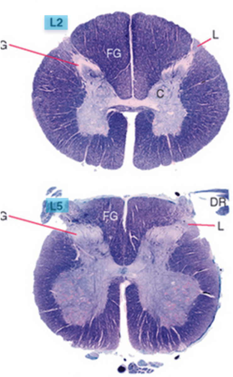 <p>lumbar; lumbosacral enlargement from T11-S1</p>