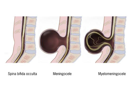 <ul><li><p>Normal event: <strong><mark data-color="yellow" style="background-color: yellow; color: inherit;"><span>Closure of the posterior neuropore</span></mark></strong></p></li><li><p class="p1"><span>Timing: Week 4 of gestation (≈ day 26–28)</span></p></li><li><p class="p1"><span>Failure leads to: Persistent opening </span>in vertebral arches <span>± neural tissue exposure</span></p></li></ul><p></p>