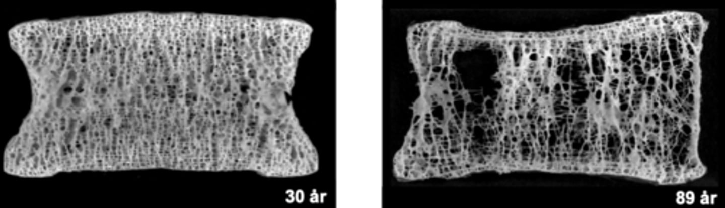 <p>Benskörhet där en benet blir poröst, vilket ökar risken för frakturer och ger minskad benmassa</p>