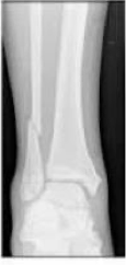 <p>what type of fracture is this?</p>