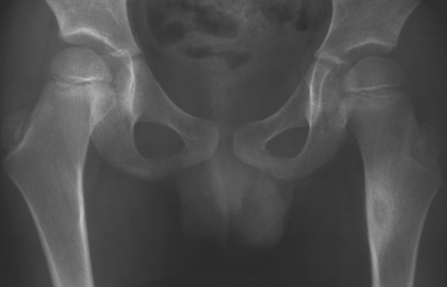 <p>unmineralized bone matrix composed of proteoglycans, glycoproteins, and collagen</p>