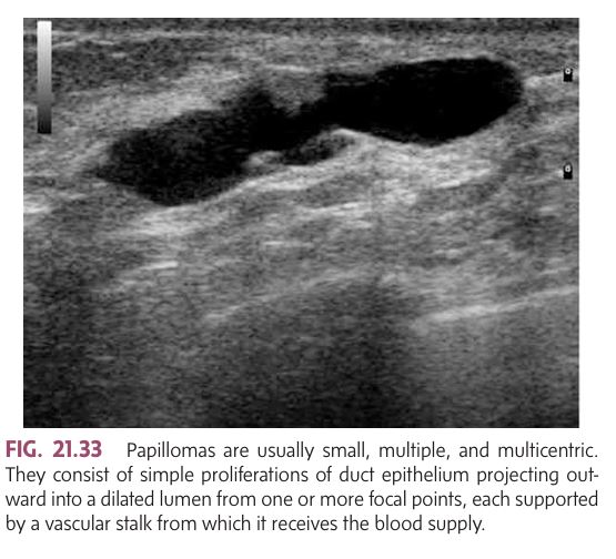 <p></p><ul><li><p class=""><strong>Definition</strong>: A small, benign tumor that grows within the <strong>acini</strong> (milk ducts) of the breast.</p><ul><li><p class=""><strong><mark data-color="yellow" style="background-color: yellow; color: inherit">Common Age Range</mark></strong><mark data-color="yellow" style="background-color: yellow; color: inherit">: </mark><strong><mark data-color="yellow" style="background-color: yellow; color: inherit">35 to 55 years</mark></strong><mark data-color="yellow" style="background-color: yellow; color: inherit">.</mark></p></li><li><p class=""><strong>Symptom</strong>: <strong>Spontaneous nipple discharge</strong> from a single duct. When discharge is abundant, it is often preceded by a feeling of <strong>fullness or pain</strong> in the areola/nipple area, which is relieved once the fluid is expelled.</p></li></ul></li><li><p class=""><strong>Sonographic Findings</strong>:</p><ul><li><p class=""><strong>small, Multiple and multicentric</strong> papillomas.</p></li><li><p class=""><strong>Raspberry-like appearance</strong> on mammogram, aiding in correlation between mammogram and ultrasound.</p></li><li><p class="">Tumors are often supported by a <strong>vascular stalk</strong>.</p></li><li><p class="">Can cause the duct to fill with <strong>blood or serum</strong> if trauma ruptures the stalk.</p></li><li><p class="">Can be <strong>palpable</strong> if large.</p></li><li><p class="">Papillomas often appear <strong>linear</strong>, resembling a terminal duct.</p></li></ul></li></ul><p></p>