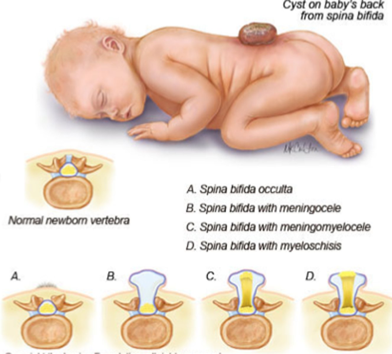 <p>The failure of the neural tube fusion that leads to vertebral defect due to lack of folic acid (nutritional deficit). This can cause paralysis, incontinence, learning difficulties, and fluid on the brain.</p>
