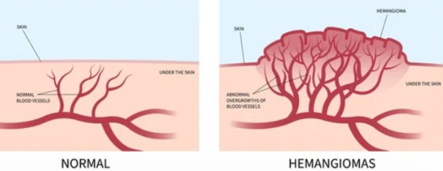 <p>What are the phases of hemangioma?</p>