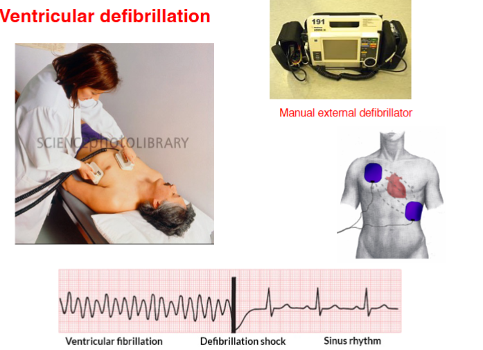 <p><span>An electrical shock is delivered through pads or paddles placed on the chest</span></p>