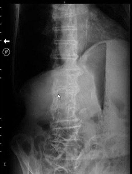 <p>prominent gastric air bubble, gastric air fluid level, dilated stomach w/ particulate matter within</p>