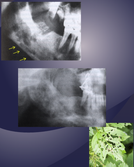 <ol><li><p>decreased bone density</p></li><li><p>loss of trabeculae sharpness </p></li><li><p>mixed radiolucent- radiopaque areas: “moth-eaten” appearance w/ irregular outline </p></li><li><p>sequestrum: islands of necrotic bone </p></li></ol><p></p>