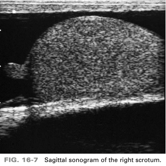 <p>a patient presents with a history of scrotal swelling and tenderness. He denies any scrotal trauma. On basis of clinical history, the sono finding are most consistent with</p>