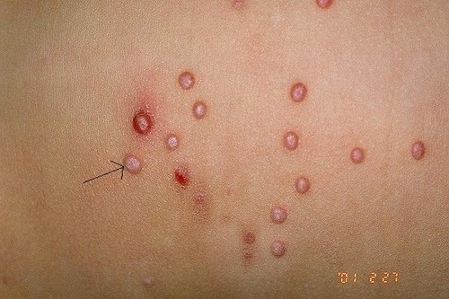 <p>solid, elevated lesions that are small (<1 cm in diameter)</p>