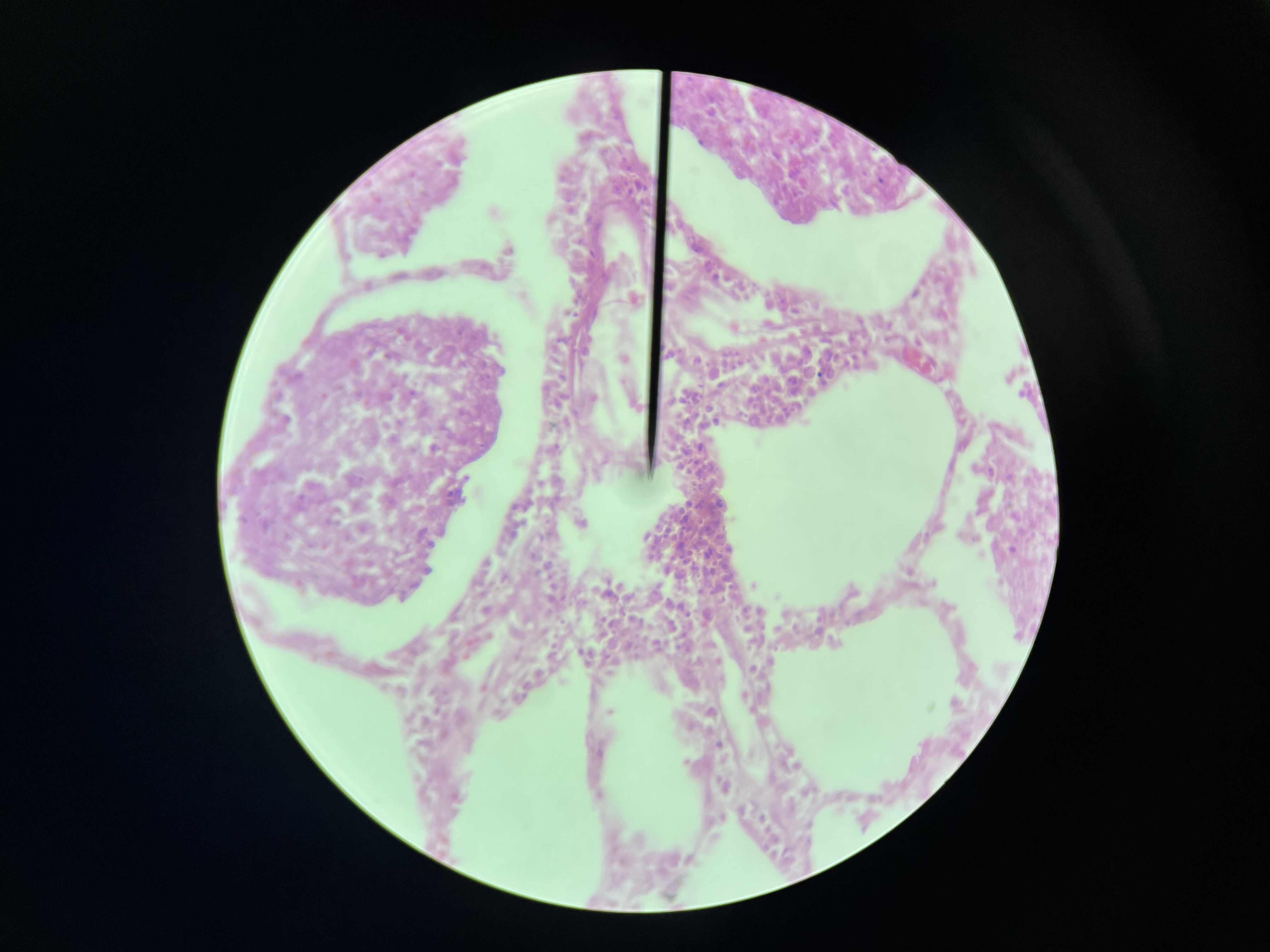 <p>A type of pneumonia characterized by the consolidation of lung tissue in one or more lobes, leading to symptoms such as cough, fever, and difficulty breathing. </p>