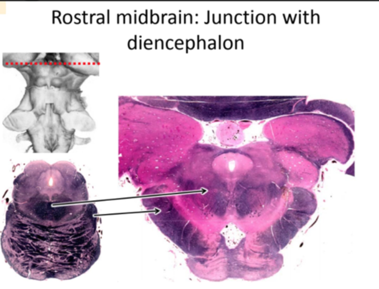 <p>- This section contains portions of both the midbrain and the diencephalon (e.g., the pulvinar and medial geniculate nuclei).<br>- Superior colliculi are gone.<br>- Cerebral peduncles have become fully developed<br>- Superior cerebellar peduncle is ending in the red nuclei<br>- Cerebral aqueduct is still present.</p>