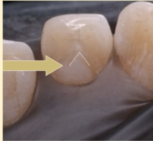 <p><mark data-color="yellow" style="background-color: yellow; color: inherit">maxillary lateral incisors #7 and #10; lingual tubercle</mark></p>
