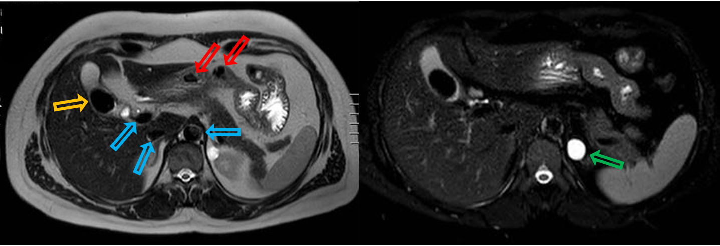 <p>Patient history: upper abdominal MRI scan in a middle-aged patient (scanned for pelvic symptoms) </p><p>Modality: left – T2W axial MRI; right – T2W fat suppressed axial MRI (without iv. contrast administration) </p><p>Region: upper abdomoen</p><p>Radiologic sign: circumscribed signal loss in the gallbladder (yellow arrow); hyperintense well circumscribed lesion in the upper pole of the upper abdomen left kidney (green arrow). Signal loss detected in several additional places: flow-void (in the aorta, inferior vena cava, portal vein, blue arrows); and gas bubbles in the intestines (red arrows) </p><p>Diagnosis: cholecystolithiasis, kidney cyst</p>