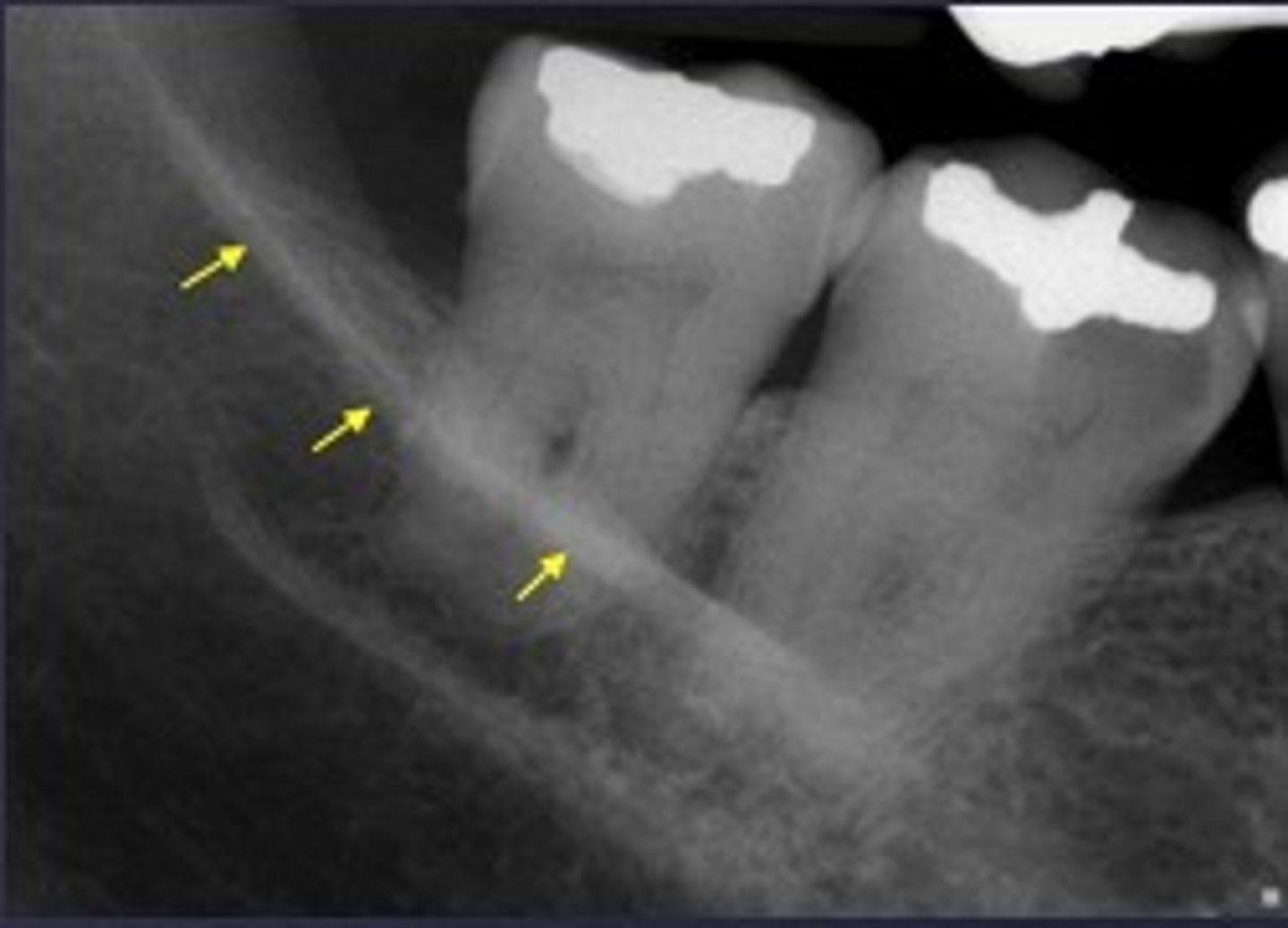 <p>Identify the radiopaque structure</p>