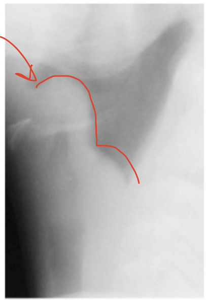 <p>Xray sign for epiglottis </p>