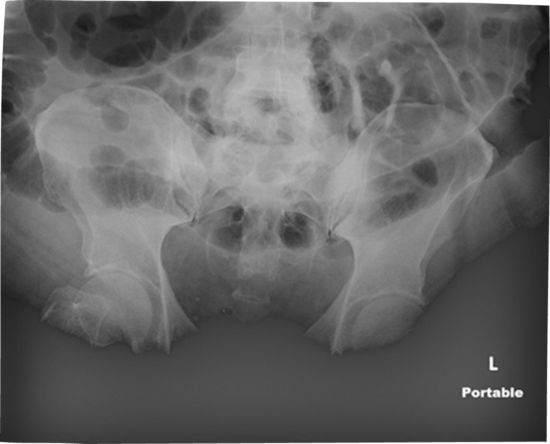 <p>The amount of radiation striking the receptor&nbsp;</p><p>Mottle</p><p>Saturation - soft tissues eliminated&nbsp;</p><p>patient and technical factors need consideration&nbsp;</p><p>S#s and EI#s are brand specific and will not be assessed on the ARRT Exam&nbsp;</p><p>(Image shows saturation - Maybe Big Belly? )&nbsp;</p>