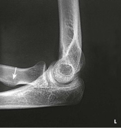 <p>What position would the hand be in for this radiograph?</p>