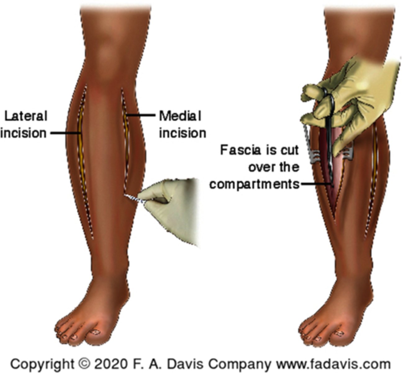 <p>fasciotomy</p>