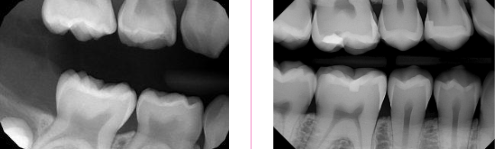 <p><span><strong>How to use the differences in identifying the dentition in </strong></span><strong>radiographs: look at the pulp</strong></p>
