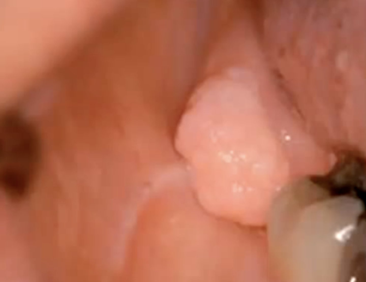 <p>a soft tissue counterpart of a central odontogenic fibroma </p>