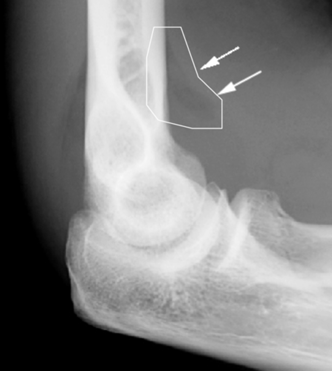 <p>Elevation of a fat pad (ex: when the elbow is injured, it fills up with fluid that pushes the fat pad and lifts it away from the bone itself)</p>