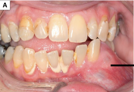 <p>Characteristic of cysts and tumors of jaw</p>