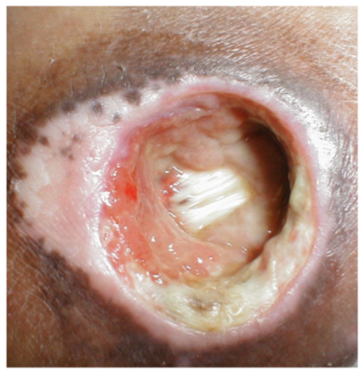<p>Full-thickness skin and tissue loss with exposed or directly palpable fascia, muscle, tendon, ligament, cartilage, or bone in the ulcer</p>