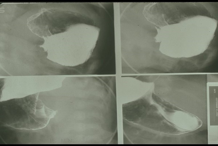 <p>What may an abdominal X-ray show for pyloric stenosis?</p>