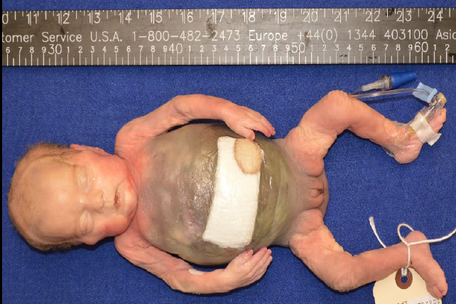 <p>inflammation/infection of bowel causing tissue death, perforation, sepsis; commonly affects premature infants.</p>