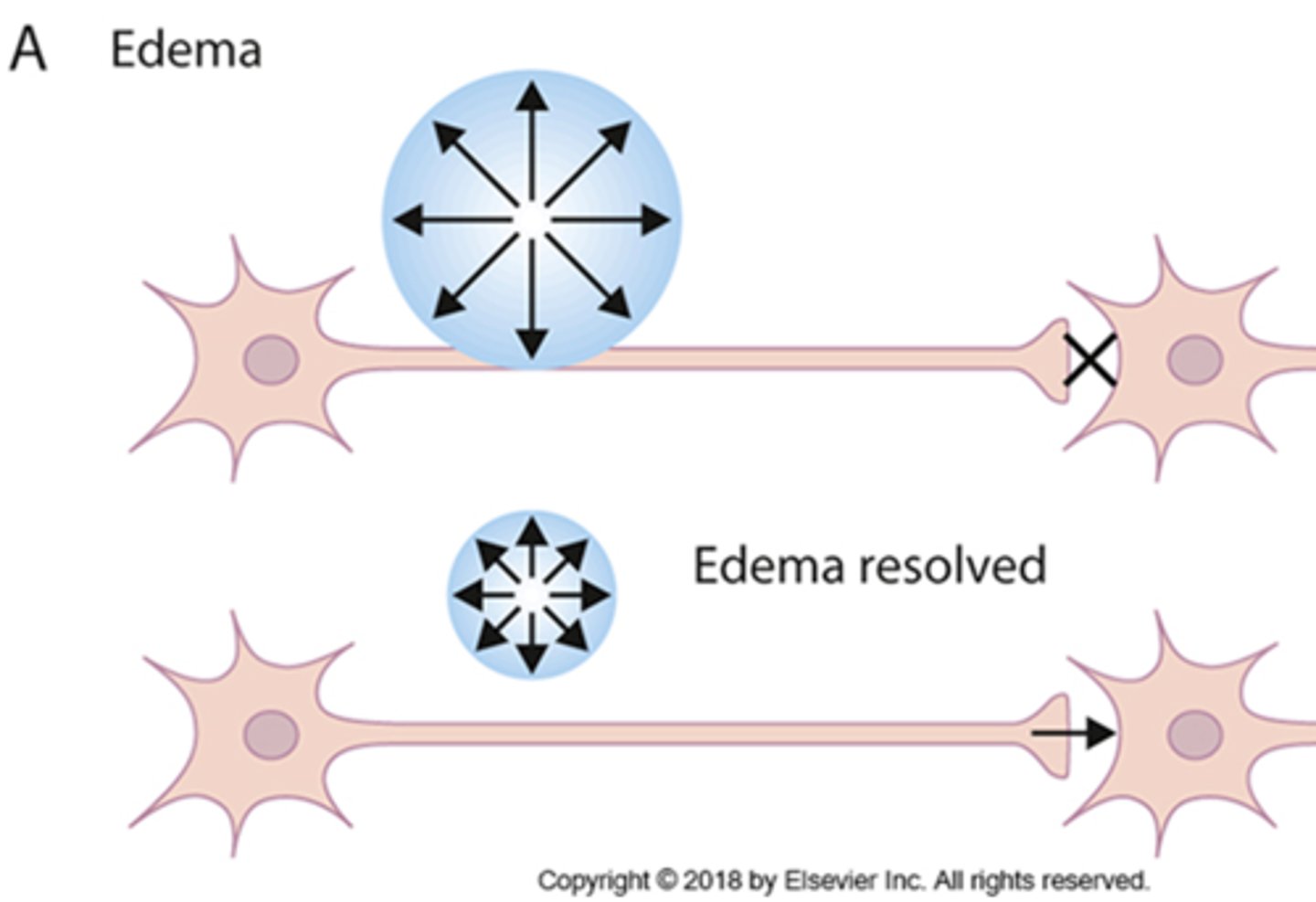<p>occurs when the swelling that caused a disruption in communication goes down and normal function is restored</p>