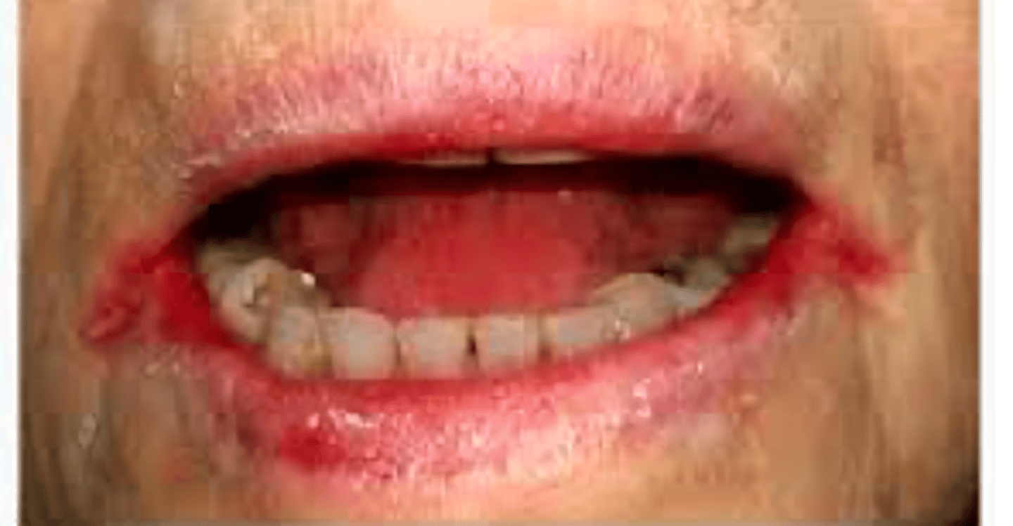 <p>What has the following characteristics?</p><p>- Dryness at the corners of the mouth leading skin breakdown, redness, crusting, fissures</p><p>- May become infected</p>