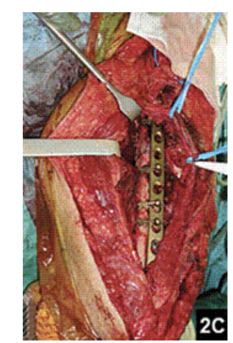 <p>This picture shows Open reduction external fixation (O.R.I.F)</p><p>(T/F)</p>