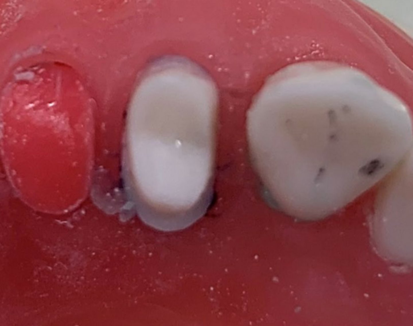 <p>What is wrong with the tooth prep on #5?</p>