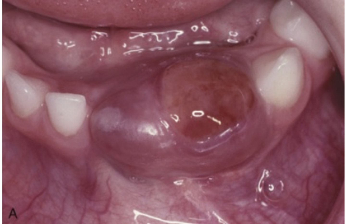 <p>What are typical characteristics of nonaggressive Central Giant Cell Granulomas?</p>