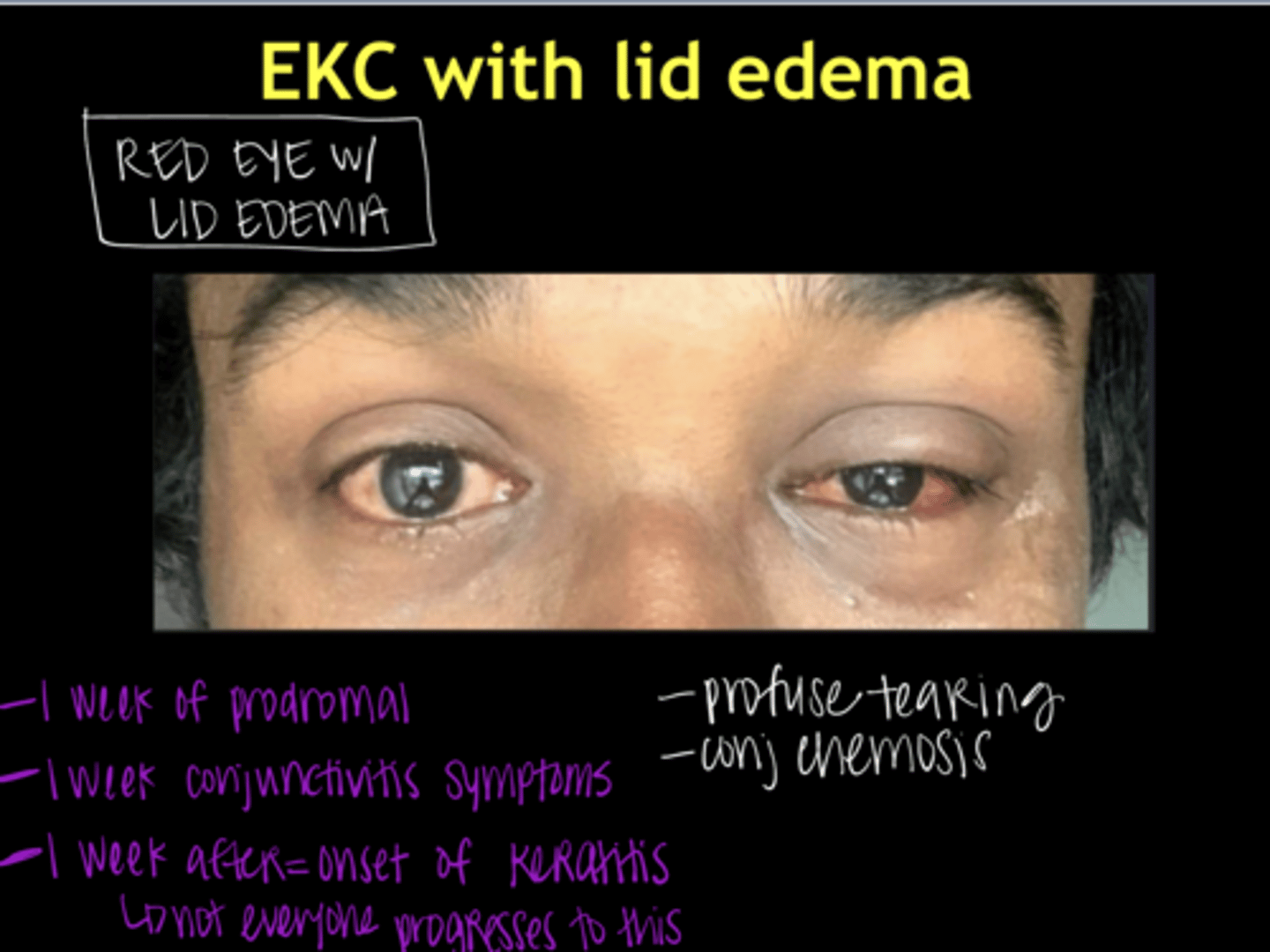 <p>EKC with Lid Edema (Pic)</p>