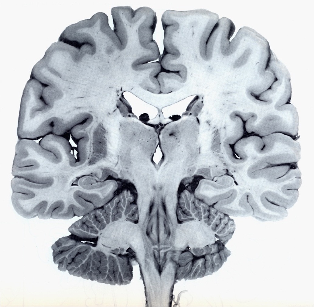 <ul><li><p><strong>White matter</strong>: Composed of <strong>myelinated axons</strong>, which are responsible for transmitting signals between different parts of the nervous system. The myelin gives it a white appearance.</p></li><li><p><strong>Grey matter</strong>: Contains <strong>collections of cell bodies</strong>, dendrites, and unmyelinated axons. It is where processing and integration of information take place in the brain and spinal cord.</p></li></ul><p></p><p></p>