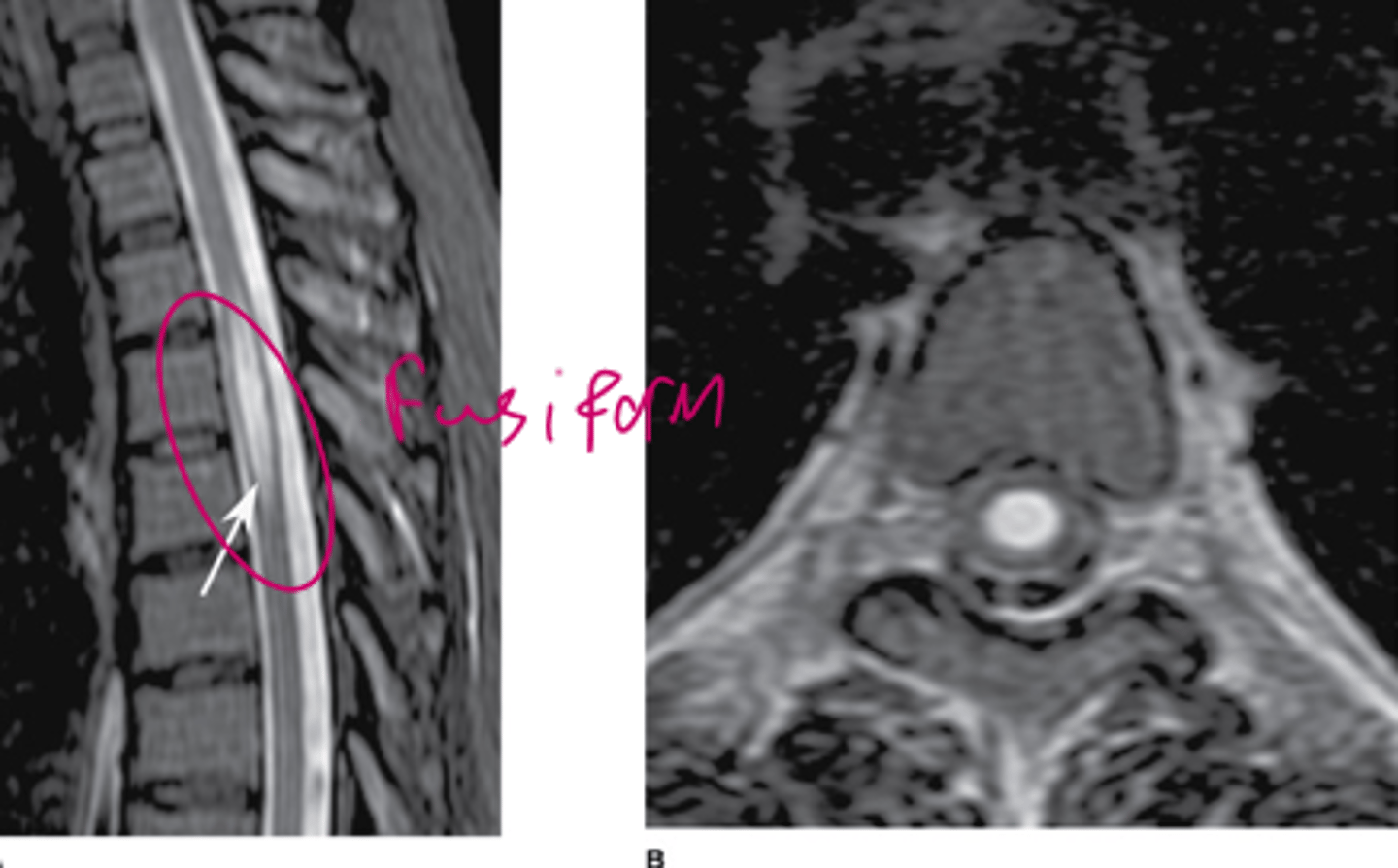 <p>The MRI most likely demonstrates</p><p>delayed posttraumatic syrinx.</p><p>subluxation.</p><p>spinal cord tumor.</p><p>abnormal bone marrow.</p><p>disk abnormality.</p>