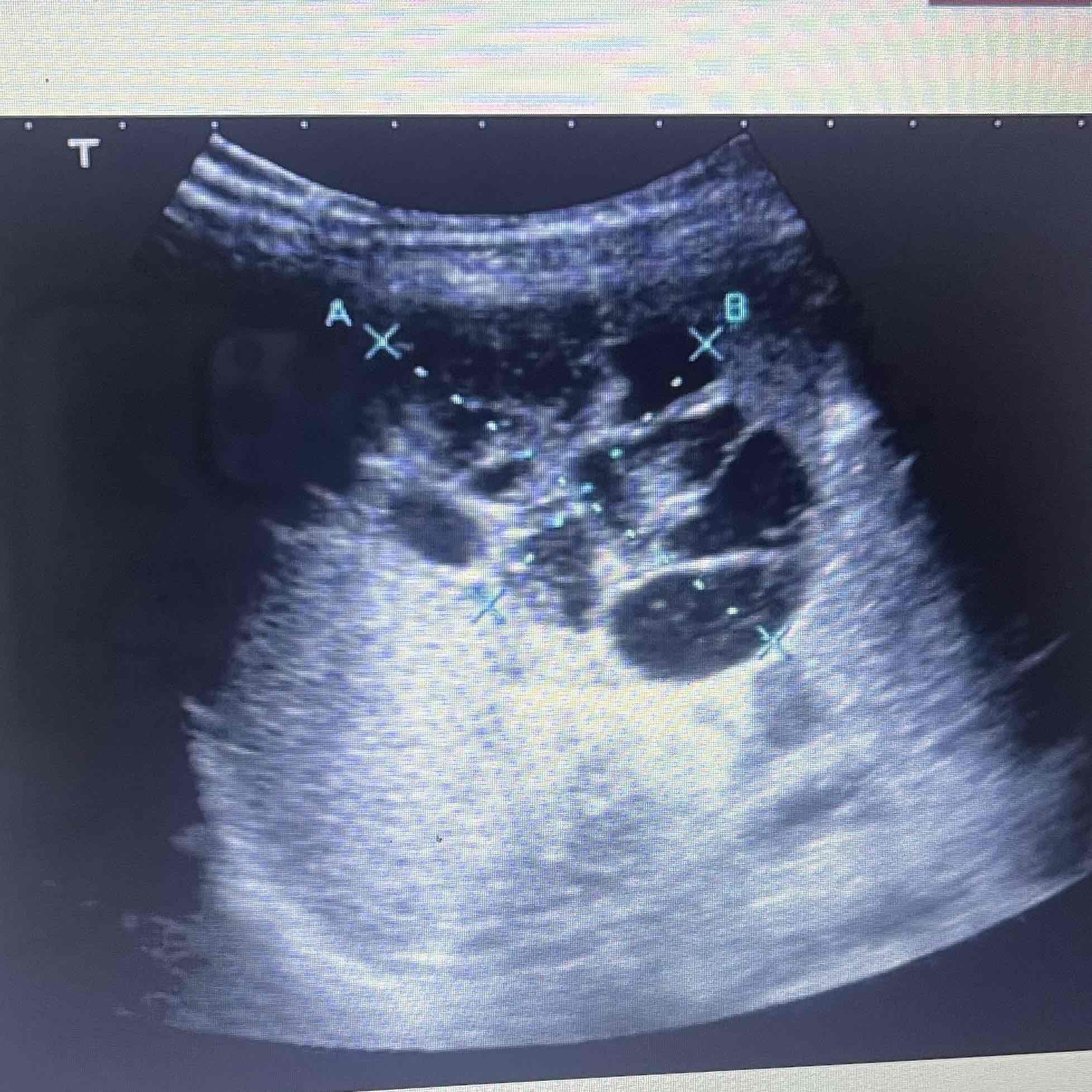 <ul><li><p>Malformation of Lymphatics</p></li><li><p>Consists of cystic spaces that vary in size</p></li><li><p>May involve other organs</p></li><li><p>Rare, benign</p></li><li><p>Clinically: Spleen- Asymptomatic, possible tenderness. Variable symptoms due to additional organs</p></li><li><p>Sonographic: Multiple cysts, solitary or grounded</p></li></ul>