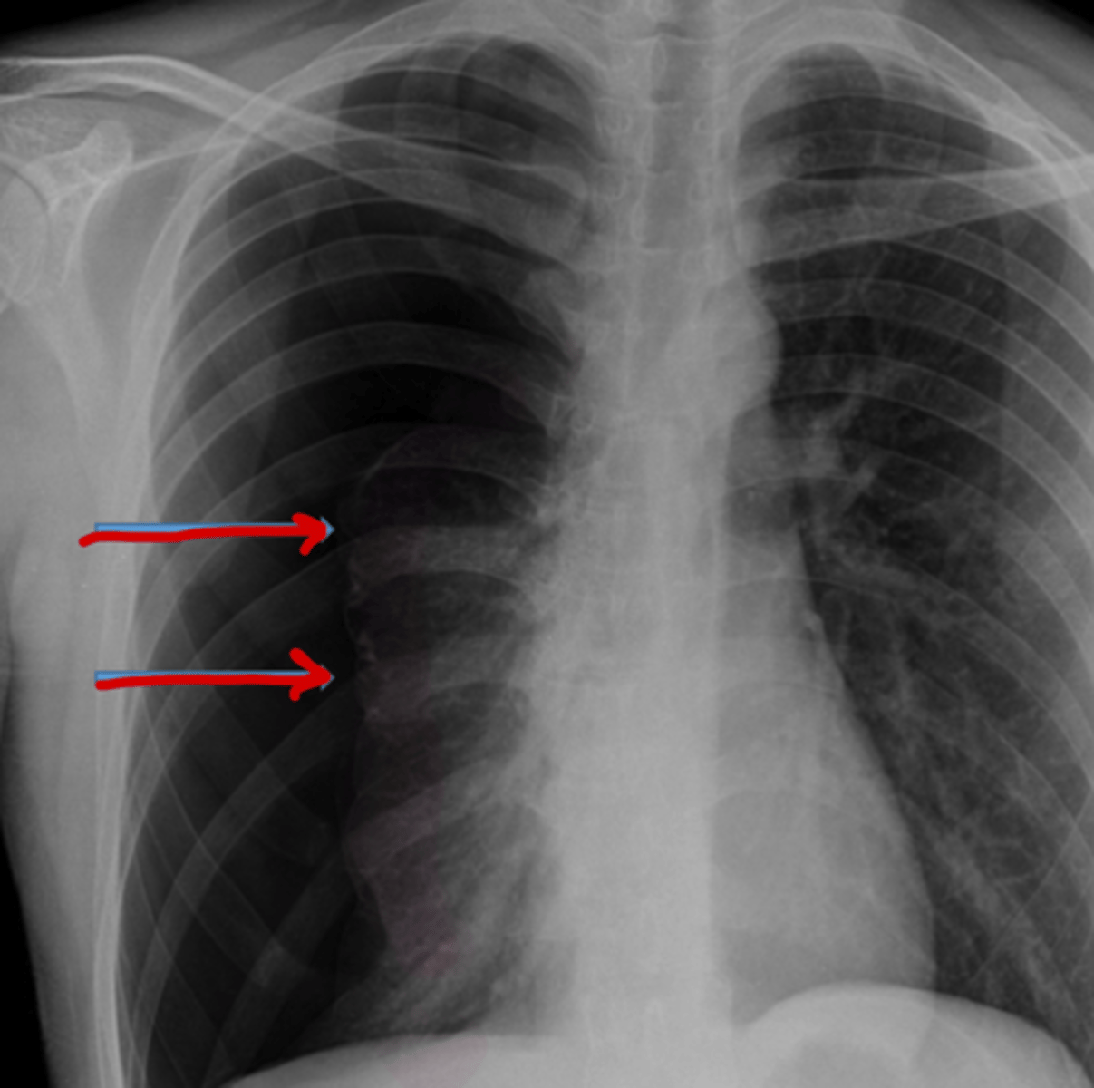 <p>what are these arrows pointing to and what disease process is it associated with?</p>